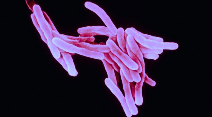 Philipp du Cros zufolge sind drei von vier Menschen mit multiresistenter TBC heute noch nicht erfasst.